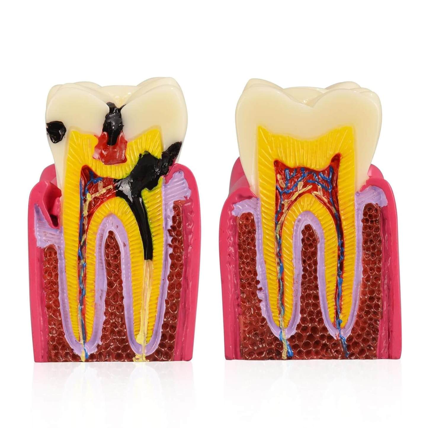 6X Dental Caries Comparison Tooth Decay Model for Teaching