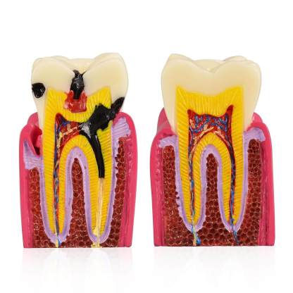 6X Dental Caries Comparison Tooth Decay Model for Teaching
