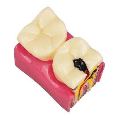 6X Dental Caries Comparison Tooth Decay Model for Teaching