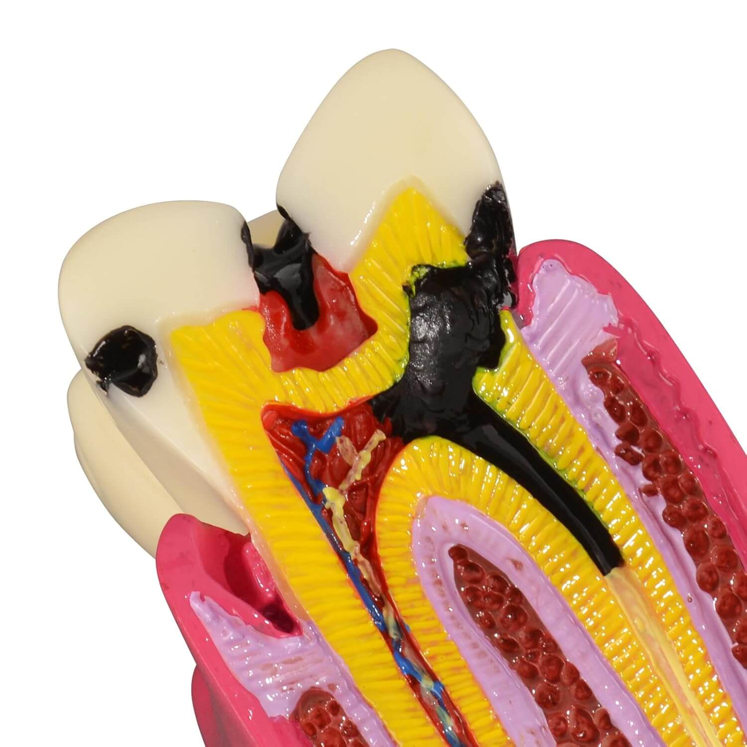 6X Dental Caries Comparison Tooth Decay Model for Teaching