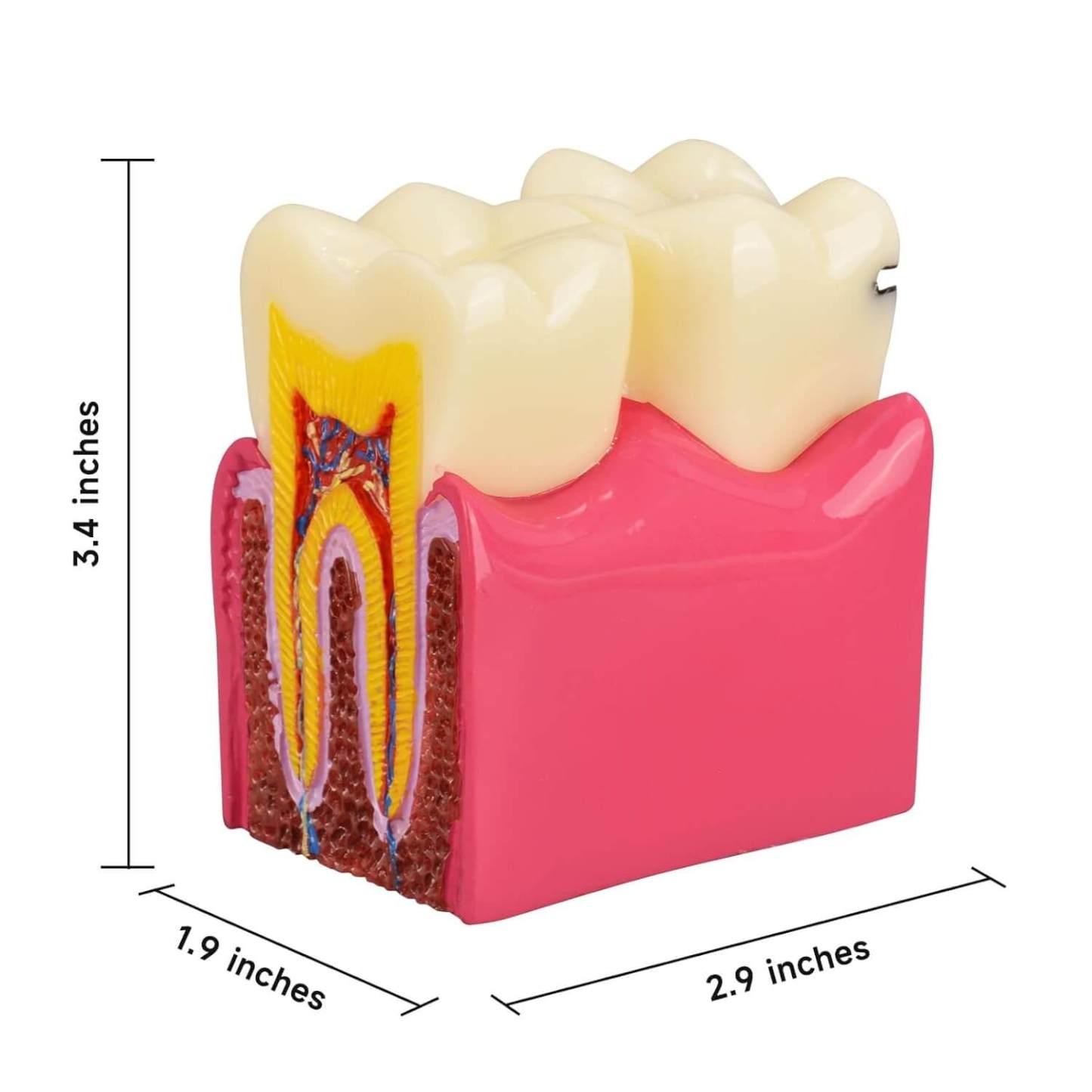 6X Dental Caries Comparison Tooth Decay Model for Teaching