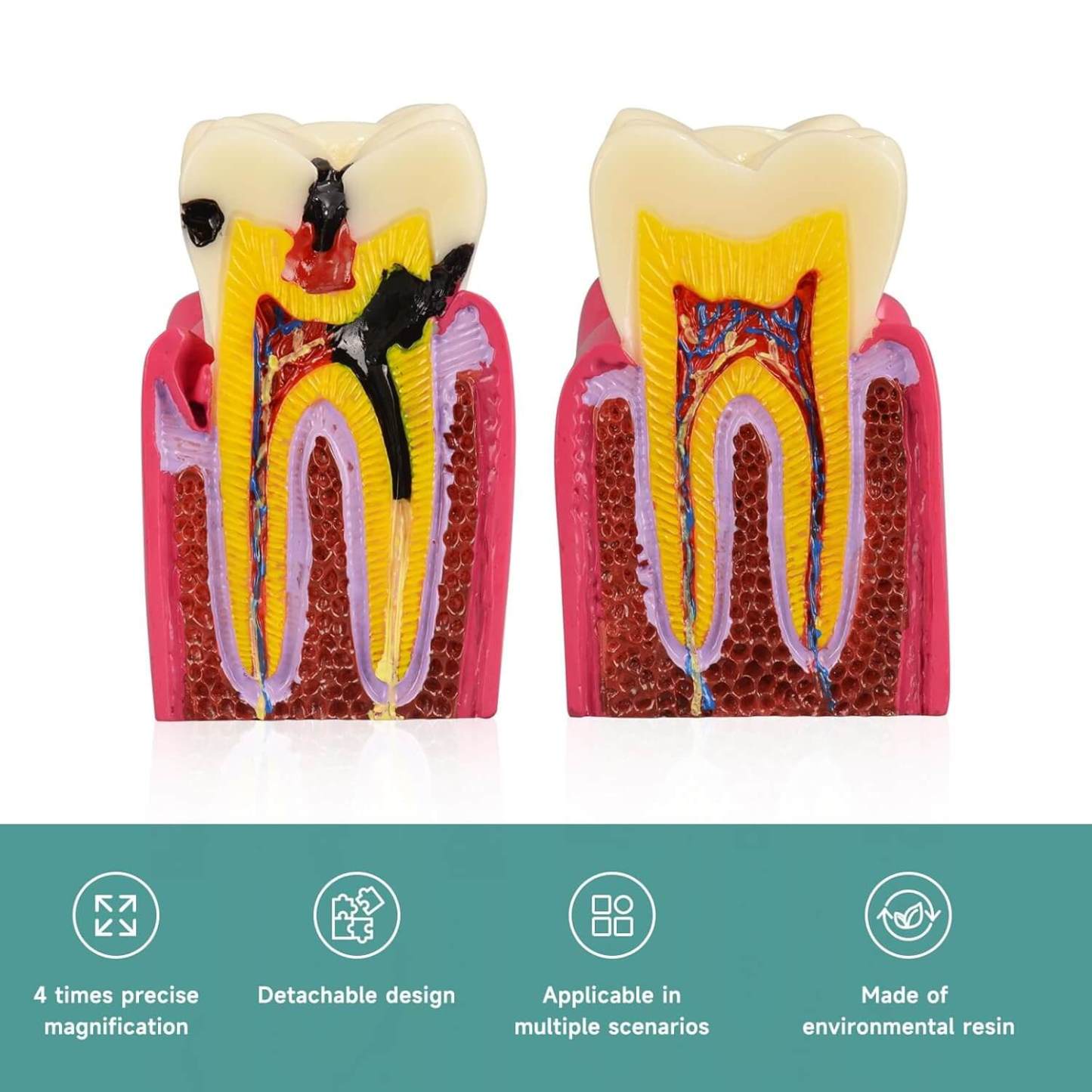 6X Dental Caries Comparison Tooth Decay Model for Teaching