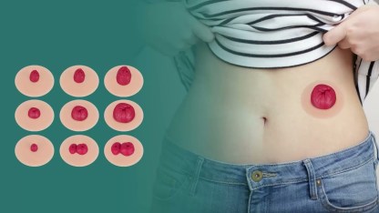 Sticky Ostomy Care Training Simulator Set (9 Stoma Models)
