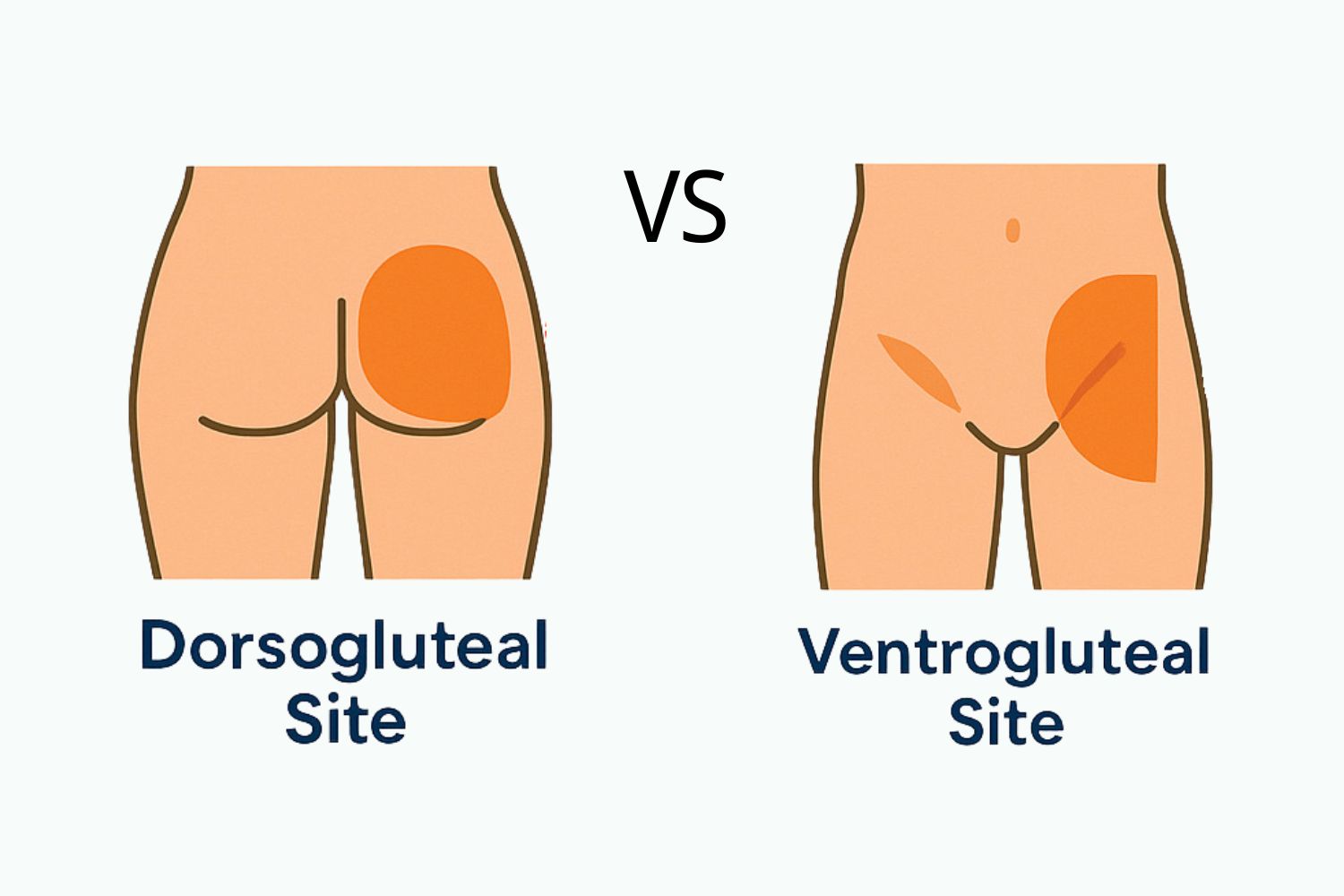 Dorsogluteal vs Ventrogluteal Injection Sites