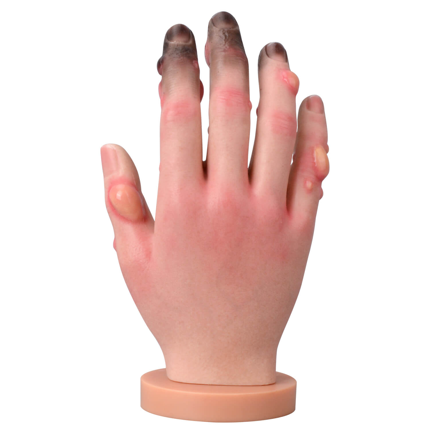 Silicone Frostbite Hand Simulation Model with Base (Stages I–IV)