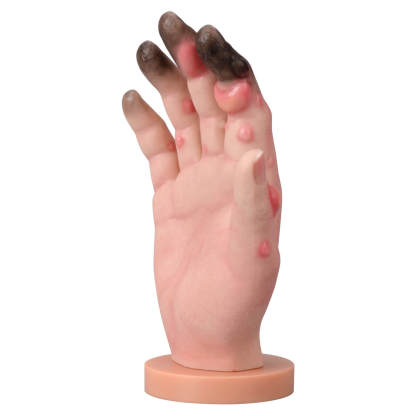 Silicone Frostbite Hand Simulation Model with Base (Stages I–IV)