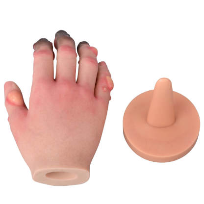 Silicone Frostbite Hand Simulation Model with Base (Stages I–IV)