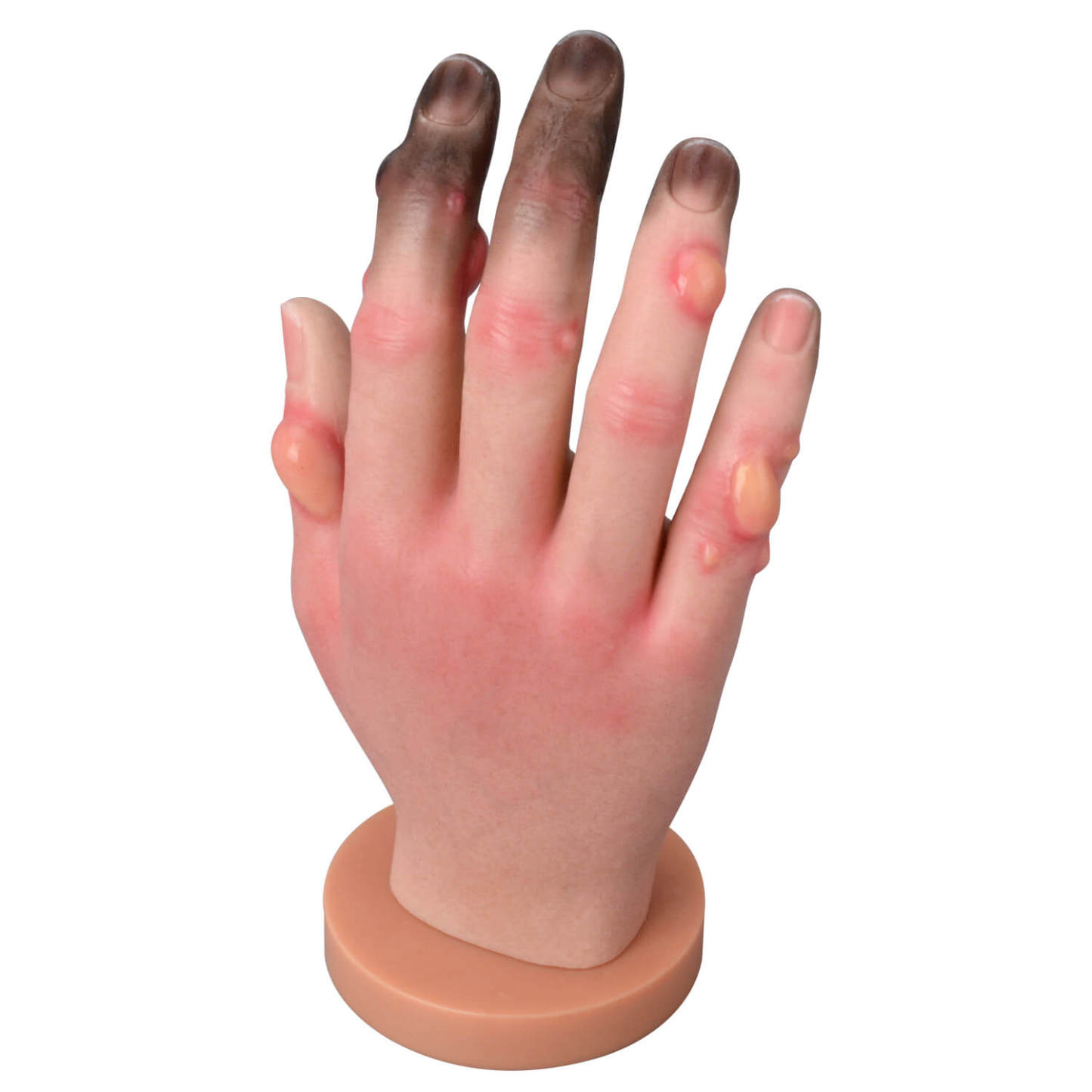 Silicone Frostbite Hand Simulation Model with Base (Stages I–IV)