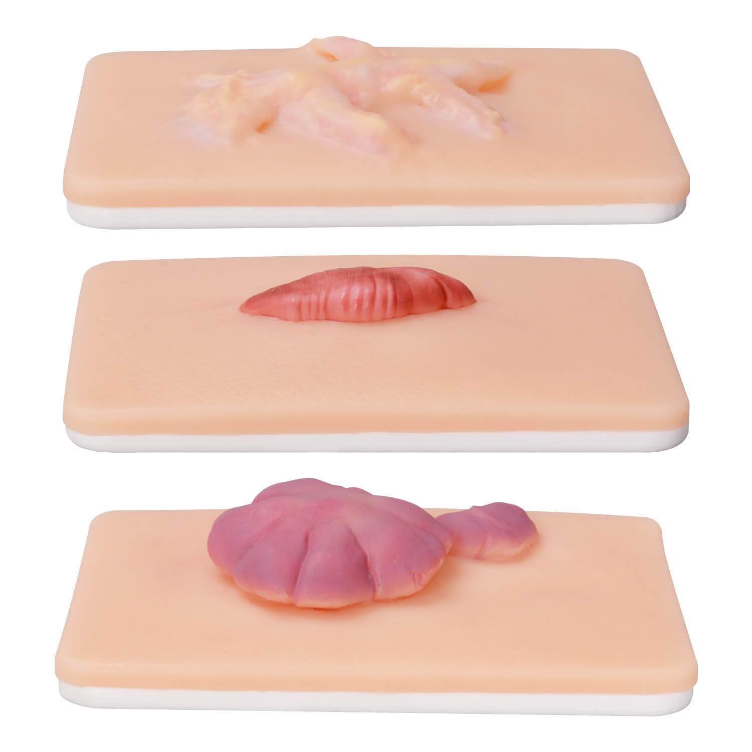 Realistic Hypertrophic & Keloid Scar Simulation Models 