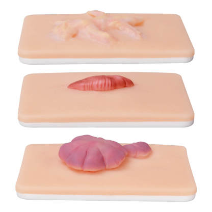 Realistic Hypertrophic & Keloid Scar Simulation Models 