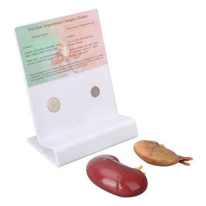 Kidney Anatomy and Hypertensive Nephropathy Teaching Model
