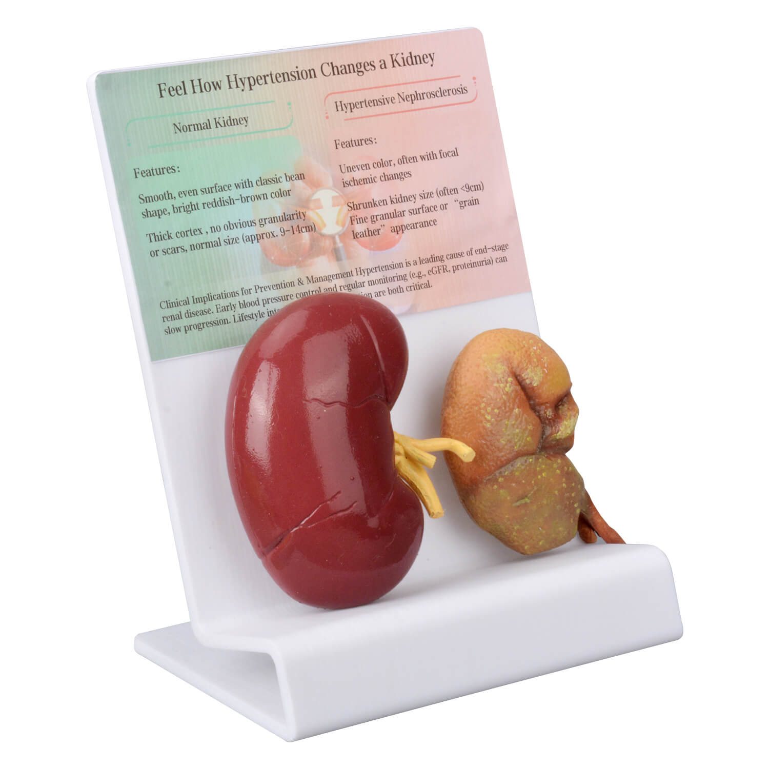 Hypertensive Nephropathy & Normal Kidney Comparison Model