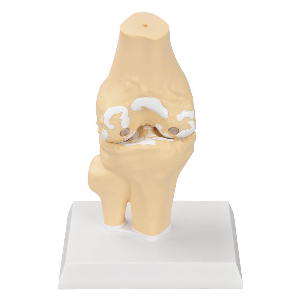 Arthritis anatomy model