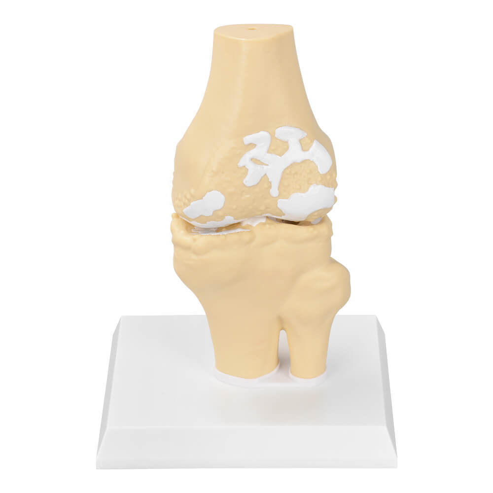 Knee Osteoarthritis Model