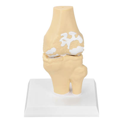 Knee Osteoarthritis Model