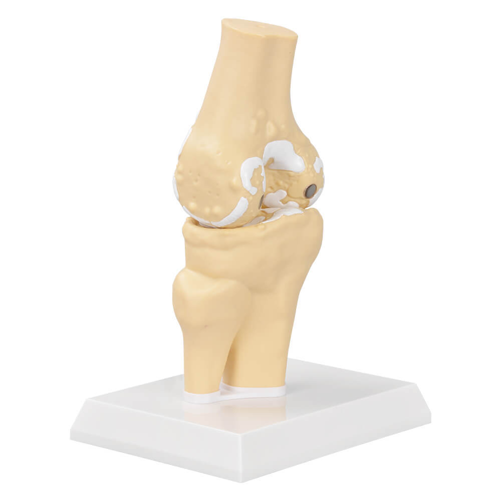 Osteoarthritis Anatomy Model