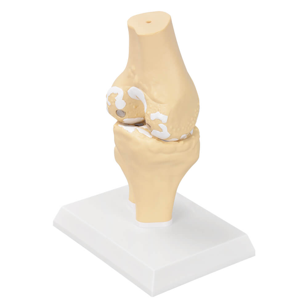 Knee Osteoarthritis Anatomy Model
