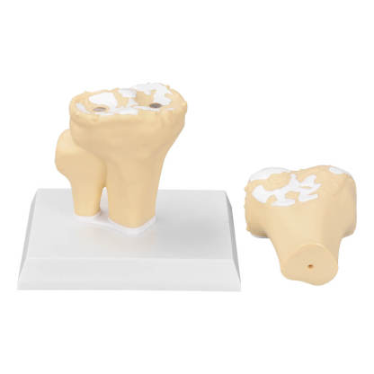 Osteoarthritis Knee Joint Model