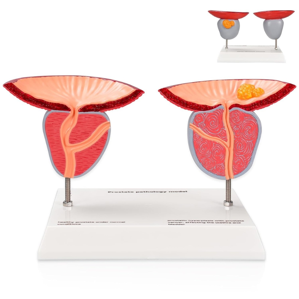 Enlarged Prostate Anatomy & Disease Comparison Model