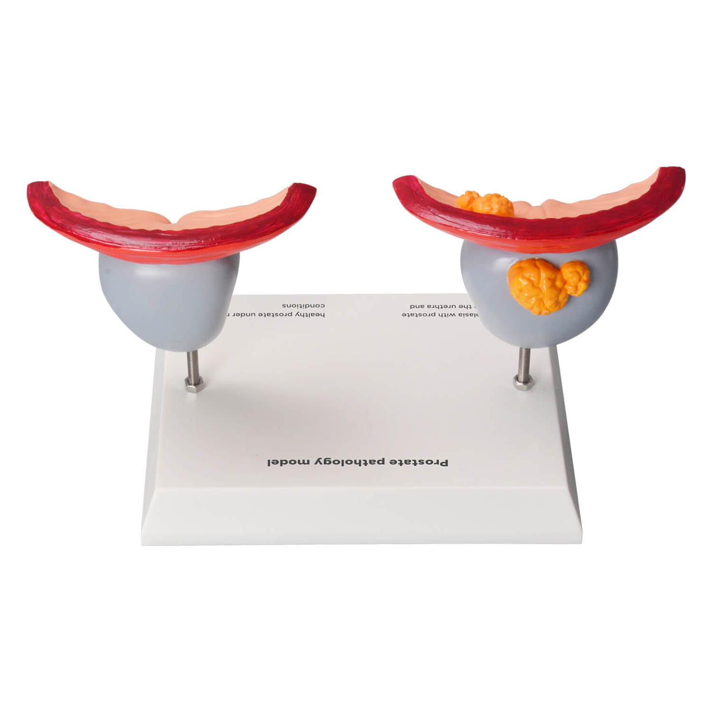 Enlarged Prostate Anatomy Model for Medical Education