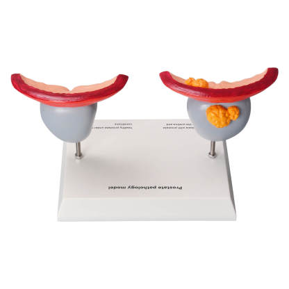 Enlarged Prostate Anatomy Model for Medical Education