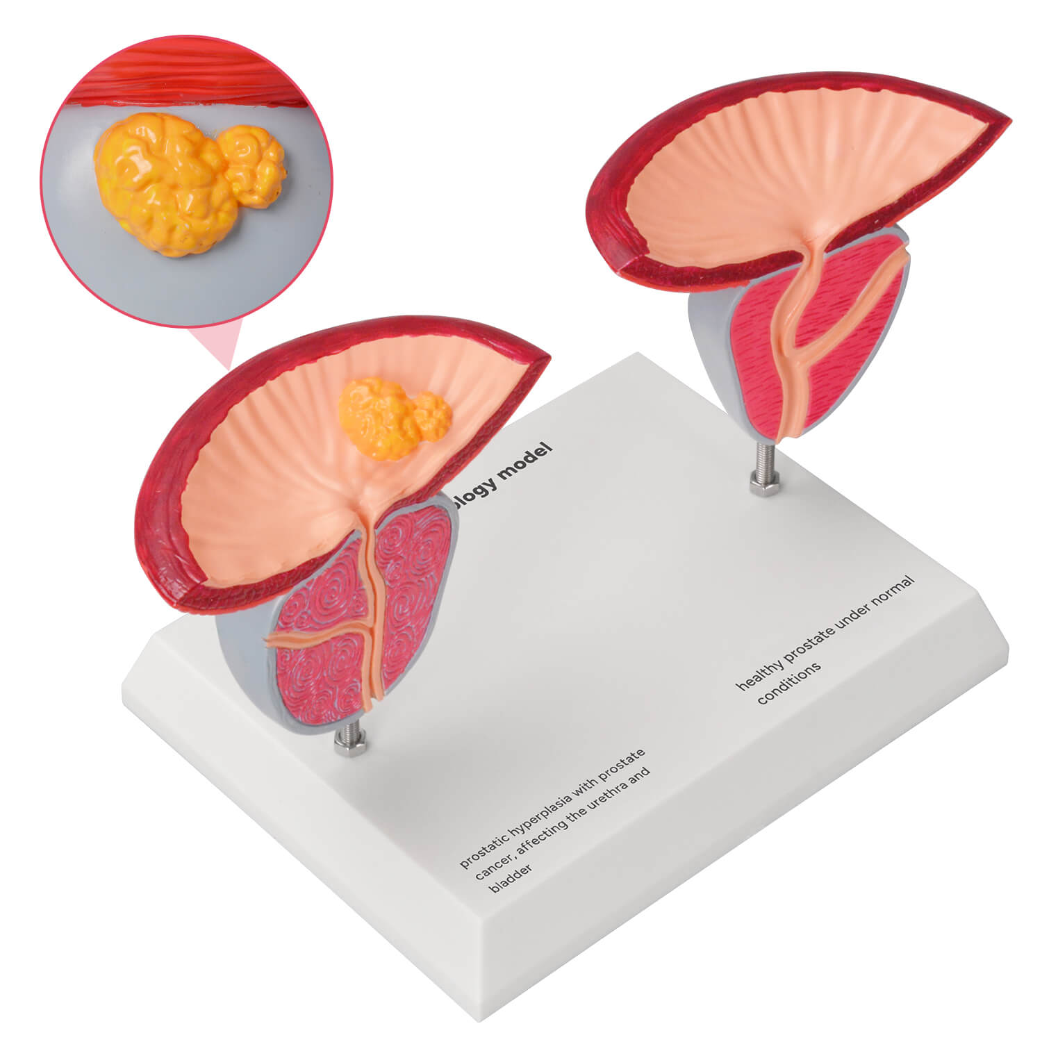 Prostate Disease Comparison Model for BPH and Prostate Cancer