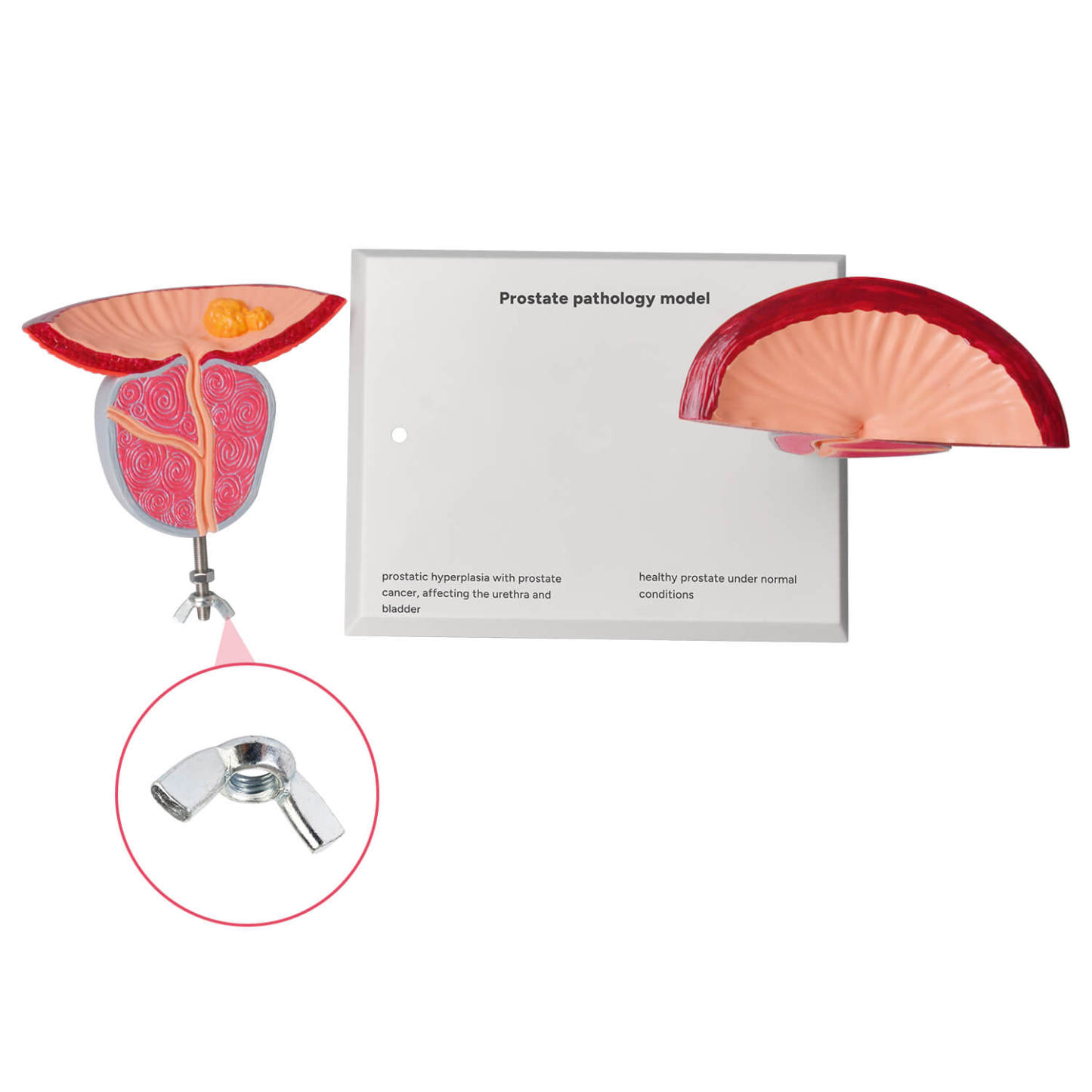 Prostate Disease Model for Urology and Patient Education