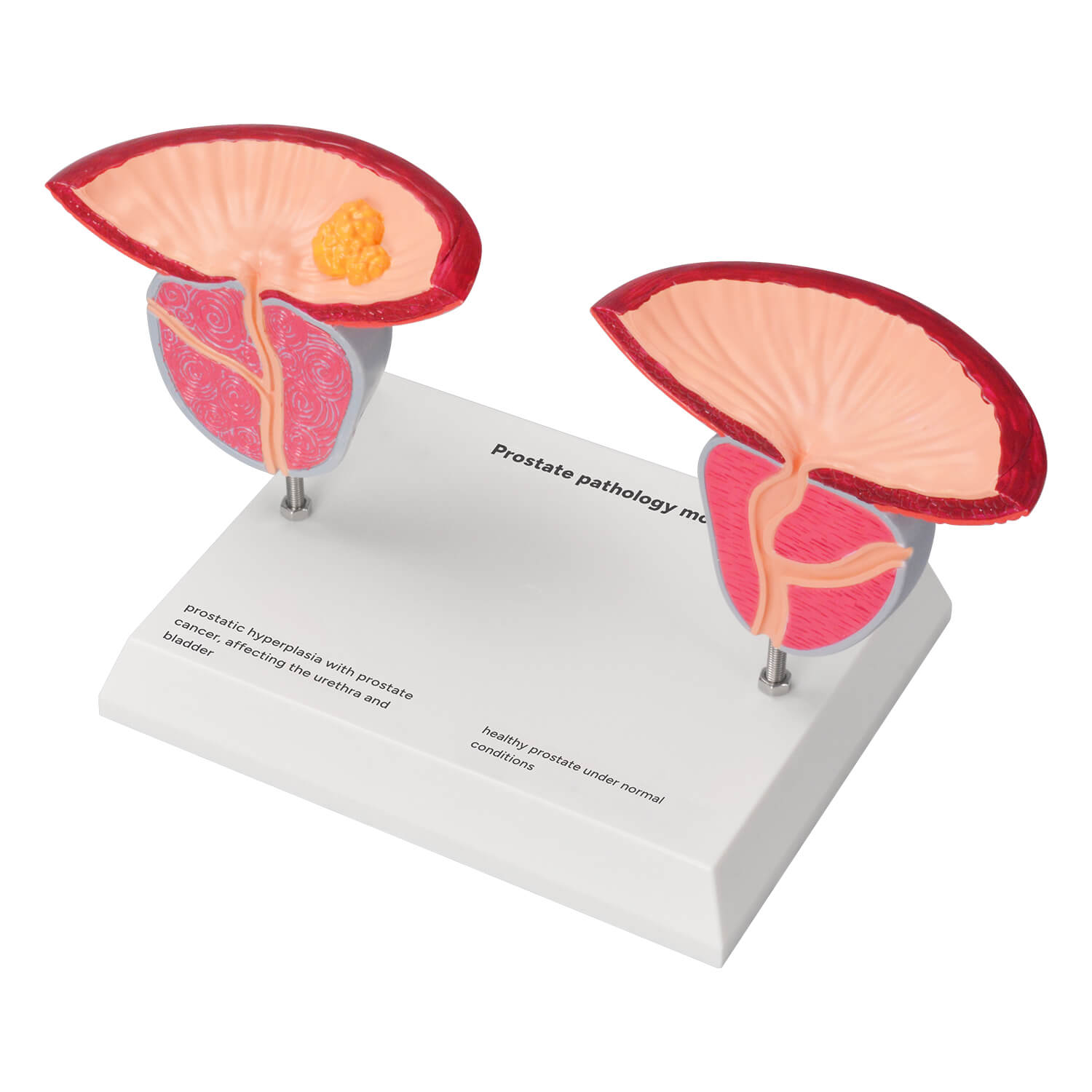 Enlarged Prostate Model Showing Normal BPH and Prostate Cancer