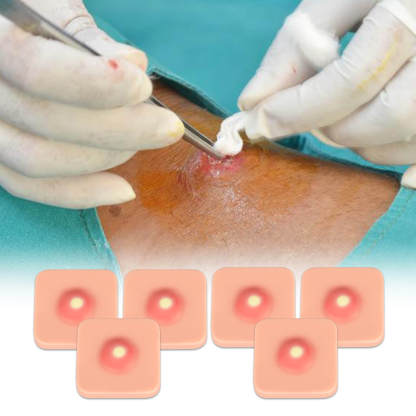 Ultrassist Abscess Simulation Trainer for I&D Incision and Drainage Practice
