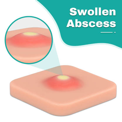 Ultrassist Abscess Drainage Trainer with SImulation Abscess
