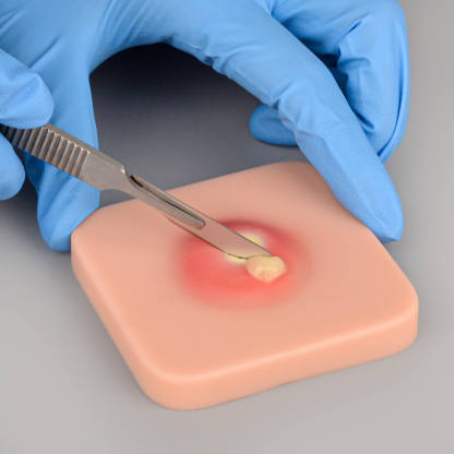 Ultrassist Abscess Simulation Pad for Incision Practice