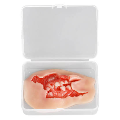 Adhesive Exposed Denture Avulsion Wound Moulage