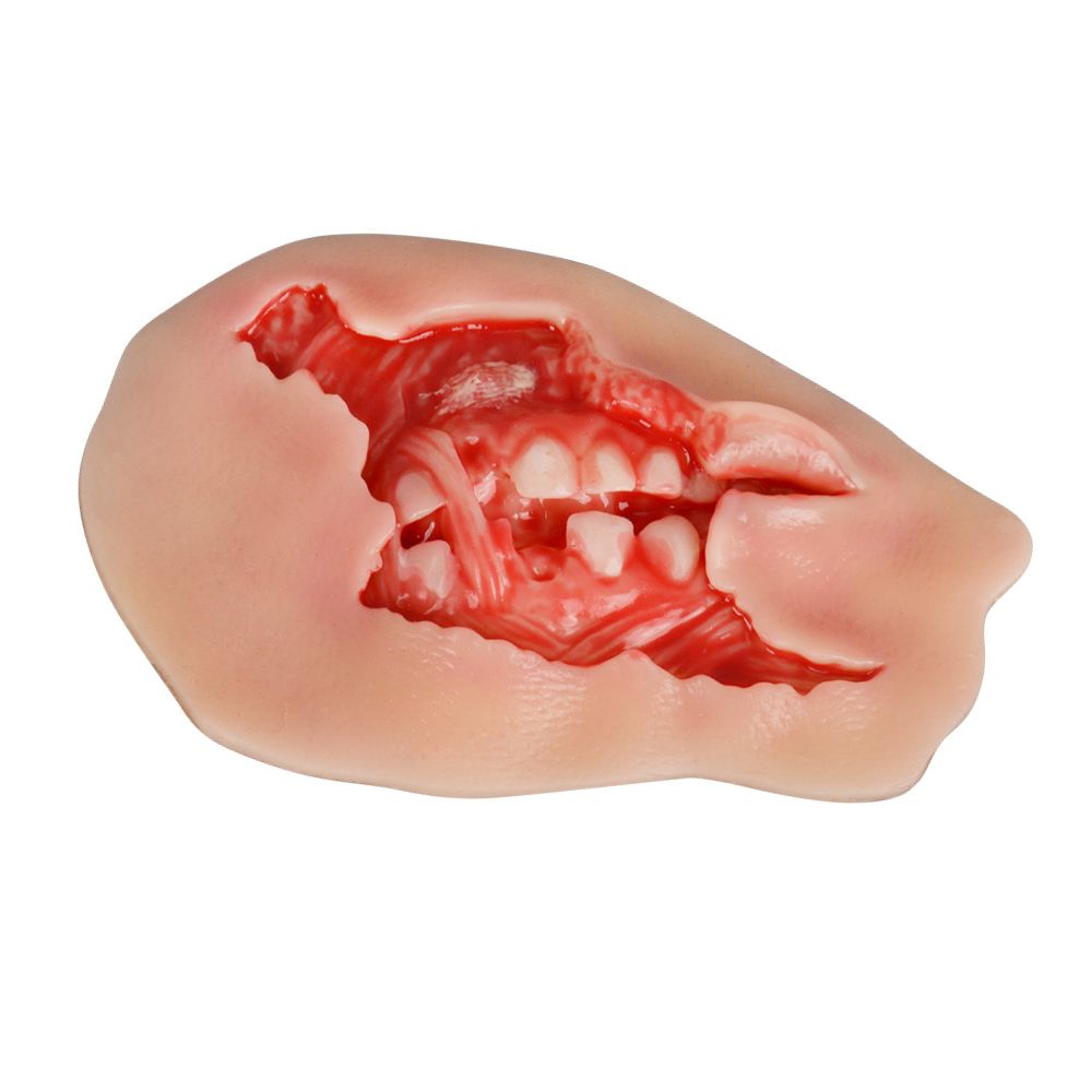Adhesive Exposed Denture Avulsion Wound Moulage