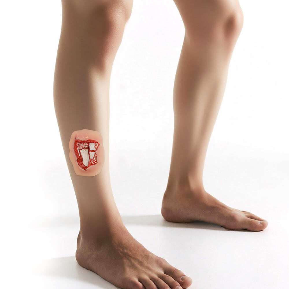 Adhesive Leg Open Fracture Wound Moulage