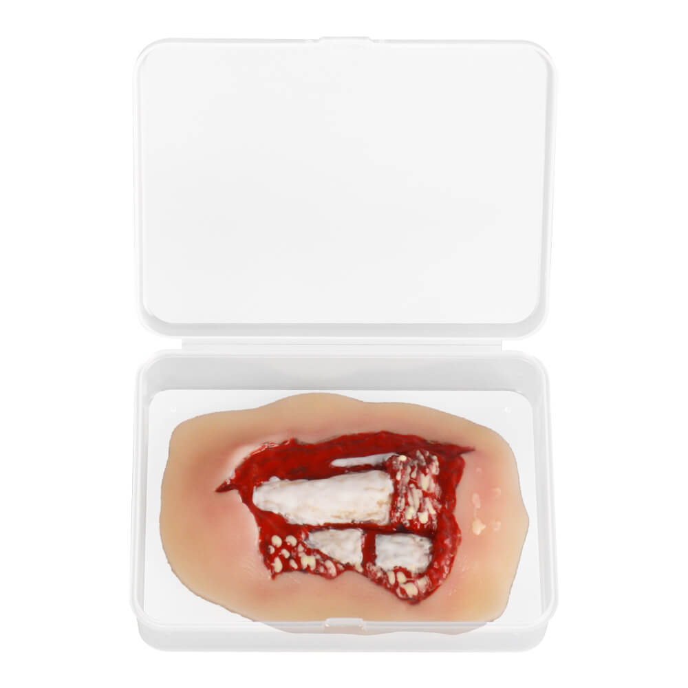 Adhesive Silicone Open Leg Fracture Wound Moulage