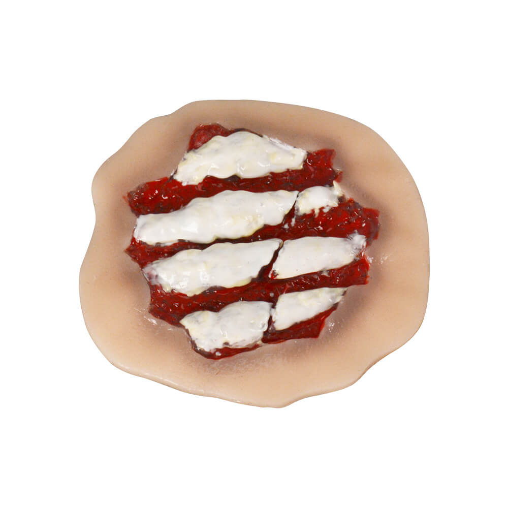 Self-Adhesive Silicone Hand Fracture Wound Moulage