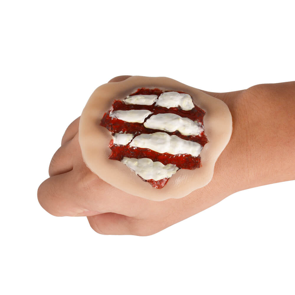 Self-Adhesive Silicone Hand Fracture Wound Moulage