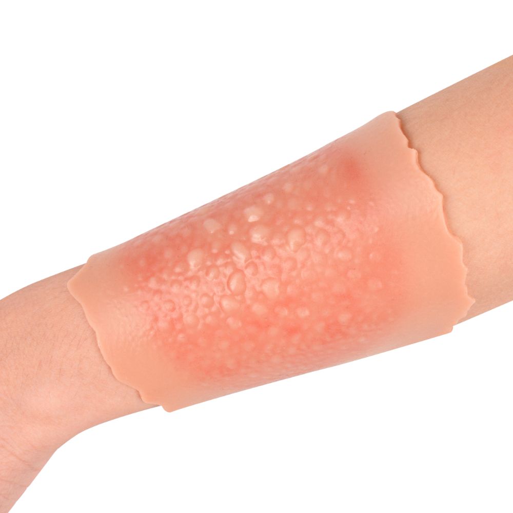 1st Degree Burn Wound Moulage