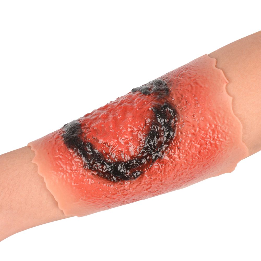3rd Degree Burn Wound Moulage