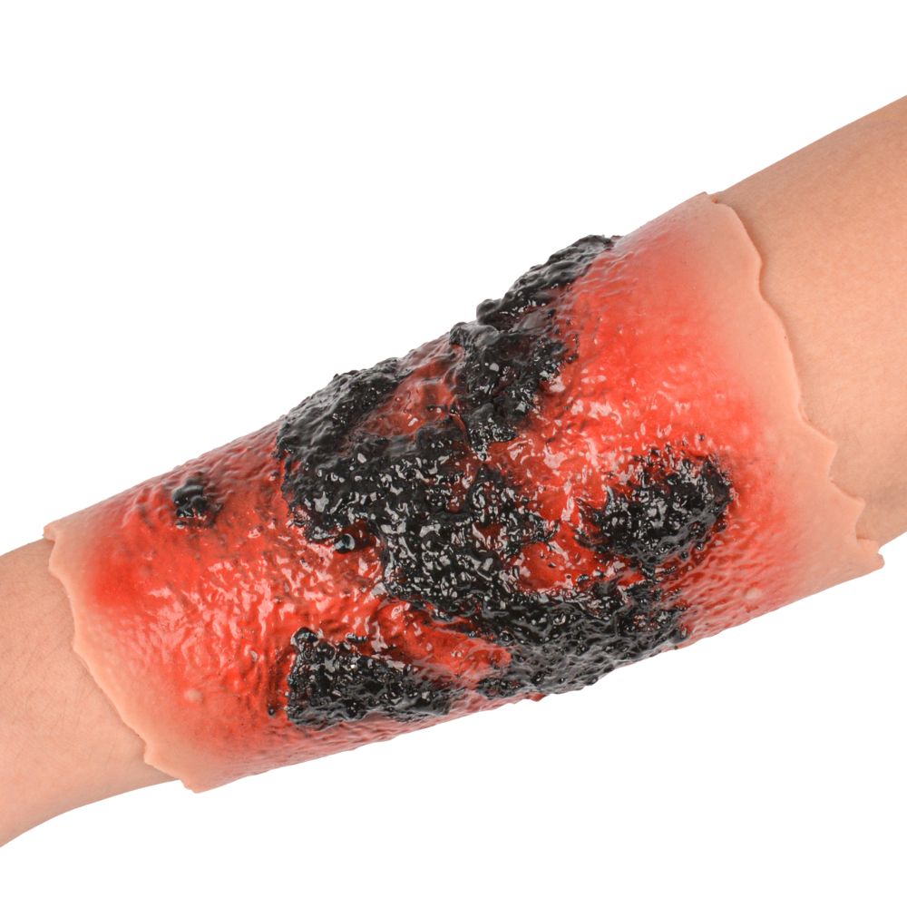 4th Degree Burn Wound Moulage