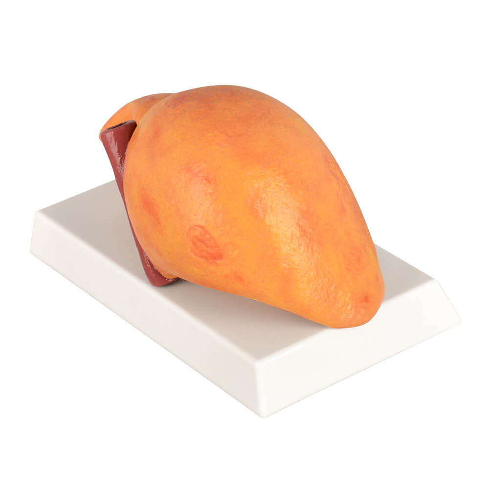 Alcoholic Fatty Liver Model with Gall Bladder