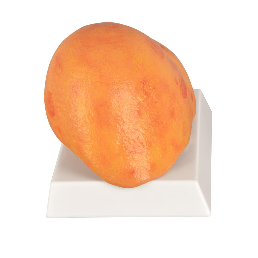 Alcoholic Fatty Liver Model with Gall Bladder