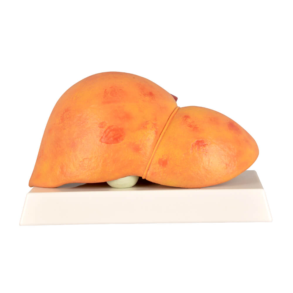 Alcoholic Fatty Liver Model with Gall Bladder