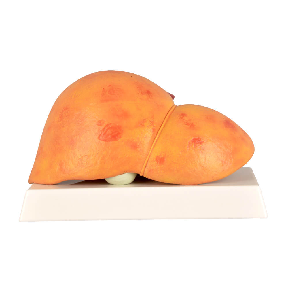 Normal & Fatty Liver Model Set with Gall Bladder