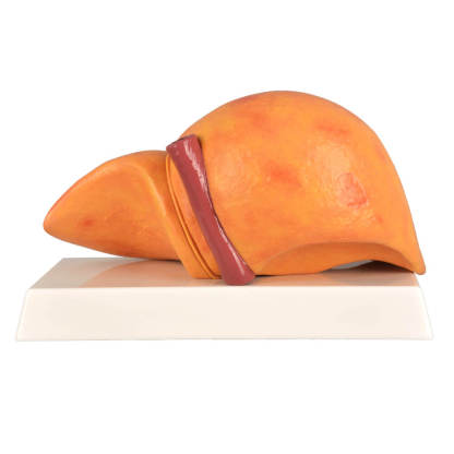 Alcoholic Fatty Liver Model with Gall Bladder