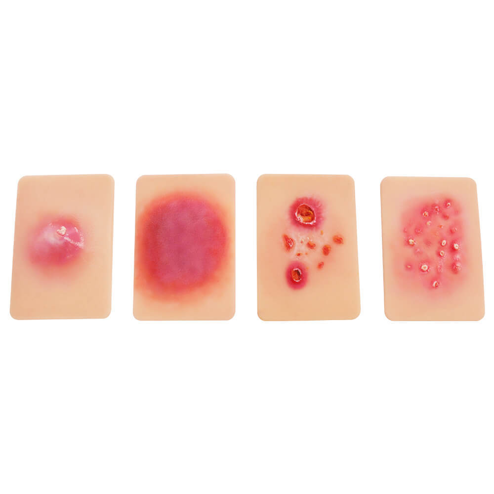 Bacterial Skin Infection Wound Model Set (4 Pieces)