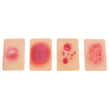 Bacterial Skin Infection Wound Model Set (4 Pieces)