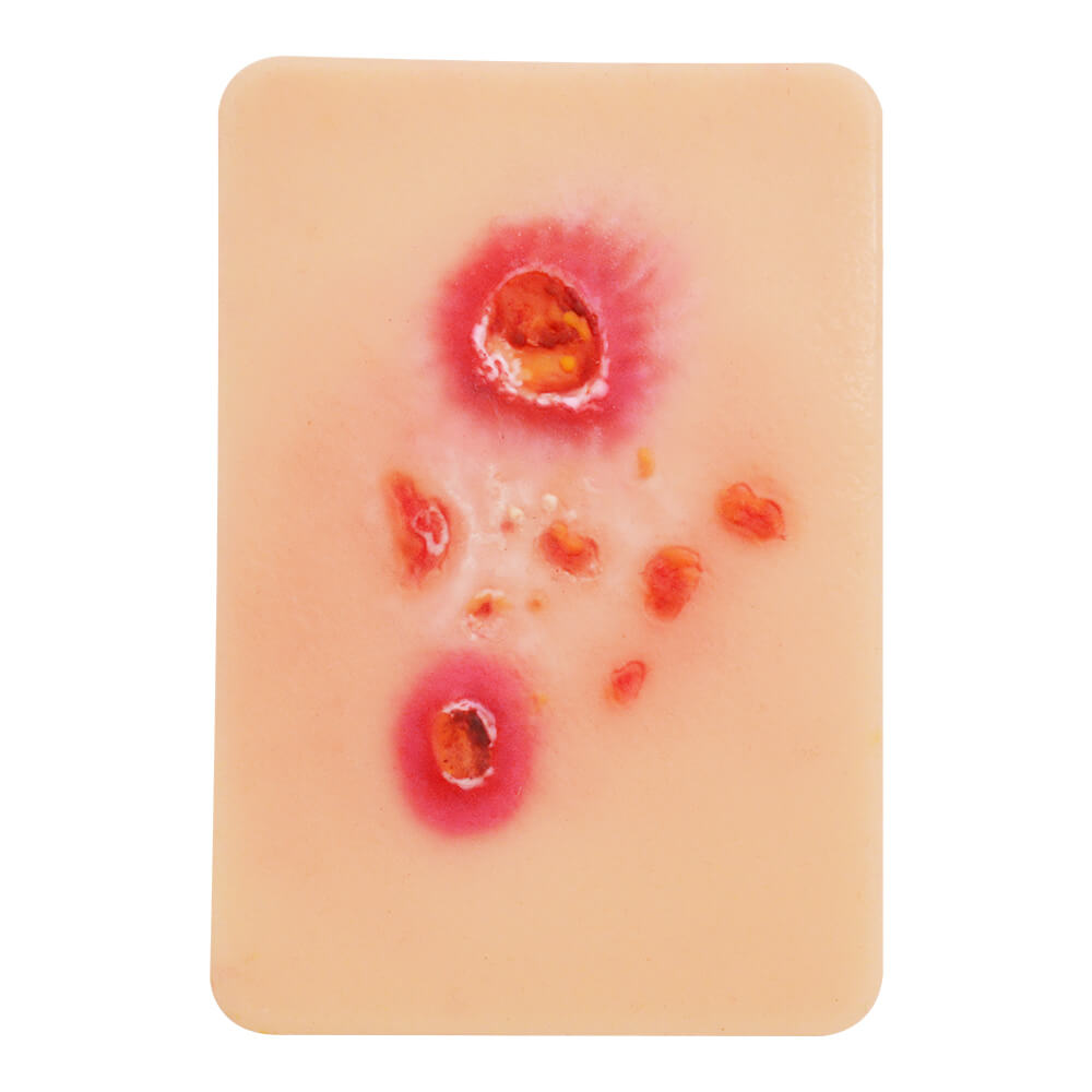 Bacterial Skin Infection Wound Model Set (4 Pieces)