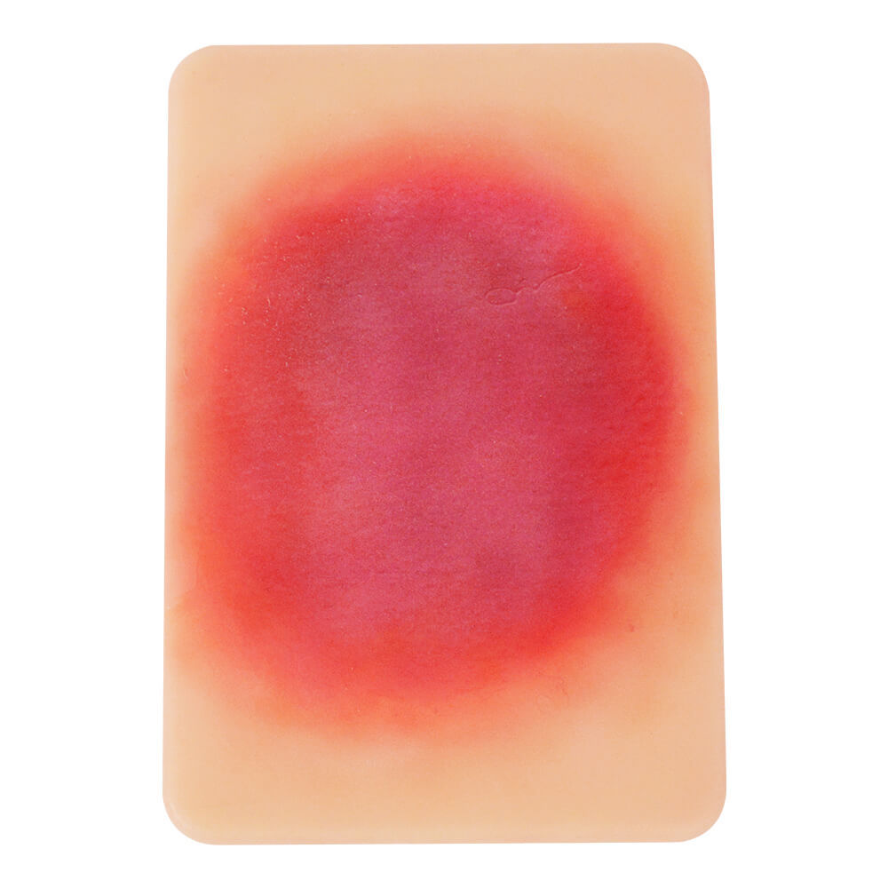 Bacterial Skin Infection Wound Model Set (4 Pieces)