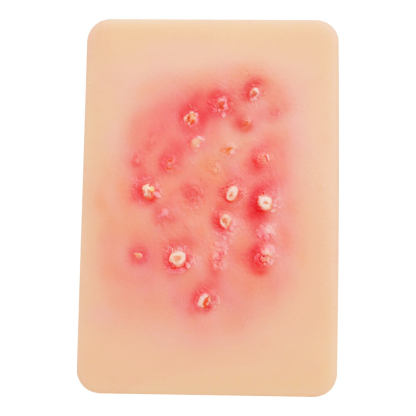 Bacterial Skin Infection Wound Model Set (4 Pieces)